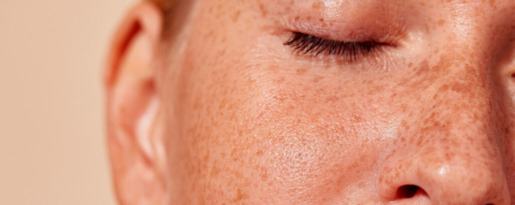 Primer plano de la piel con pecas y textura natural