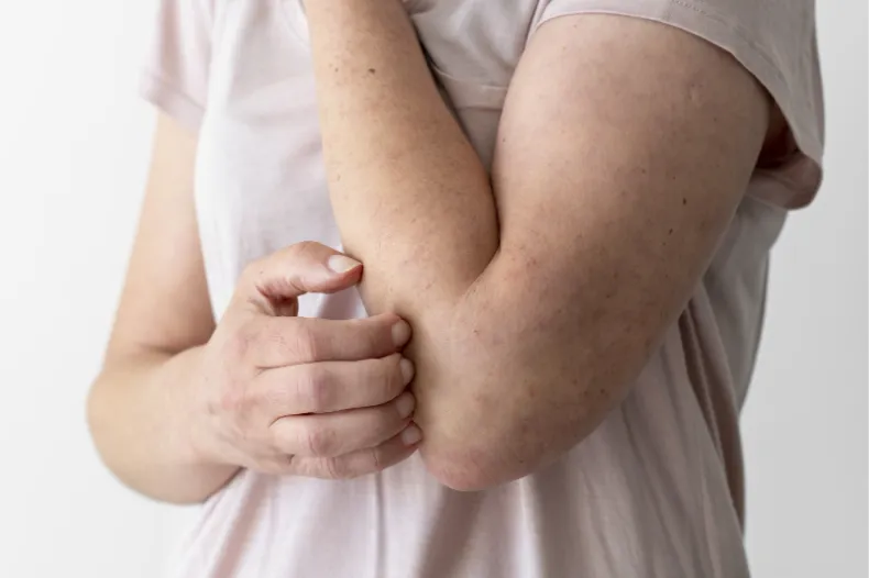 Mujer con alergia en los brazos rascándose.