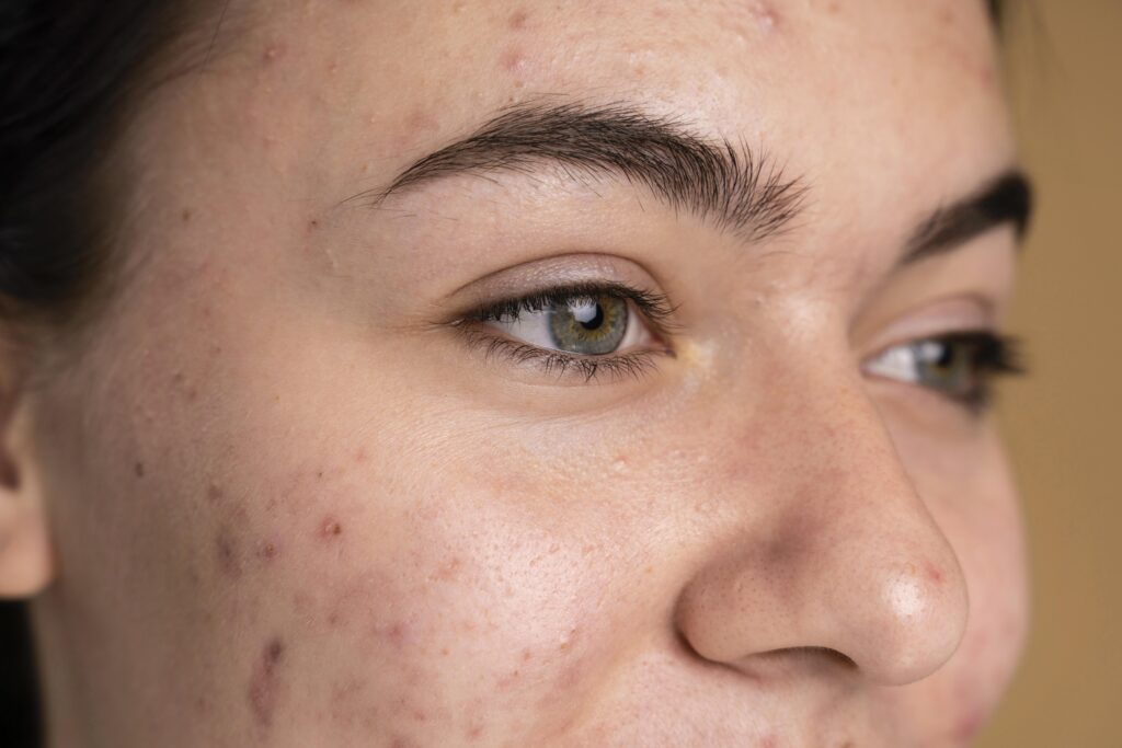 Mujer joven con acné en un plano detallado de su rostro.